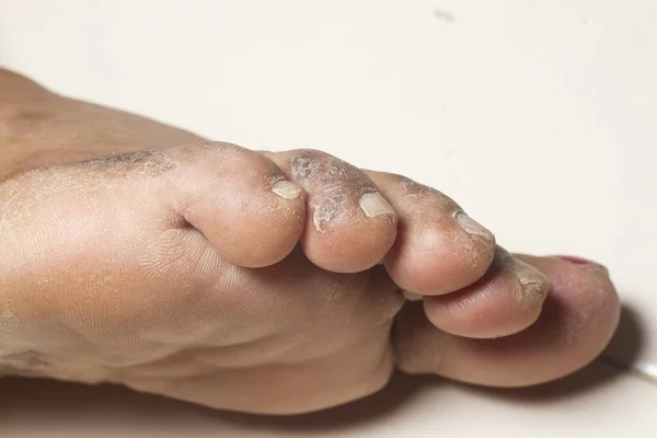 Beyaz arka planda kronik sedef hastalığından muzdarip bir kadının bacakları. Hastanın cildinde kızarıklık ve pullanma var. Dermatolojik sorunlar. Kuru cilt.