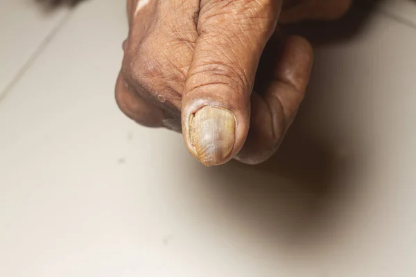 Fungus Infection on Nails of old woman\'s thumb.