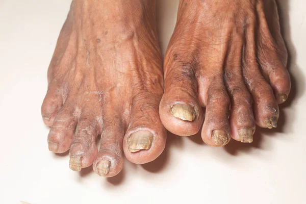 Fungus Infection on Nails of old woman\'s Foot