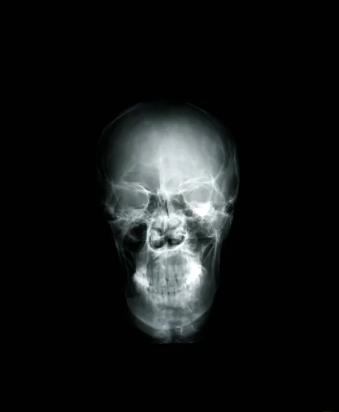 Ακτινογραφίες Κεφαλής Που Χρησιμοποιούνται Για Διάγνωση Νευρολογικών Και Ογκολογικών Παθήσεων — Φωτογραφία Αρχείου