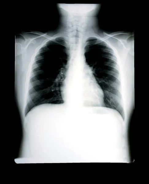 Photos Film Radiographie Thoracique Système Respiratoire Pour Diagnostic Dans Traitement — Photo