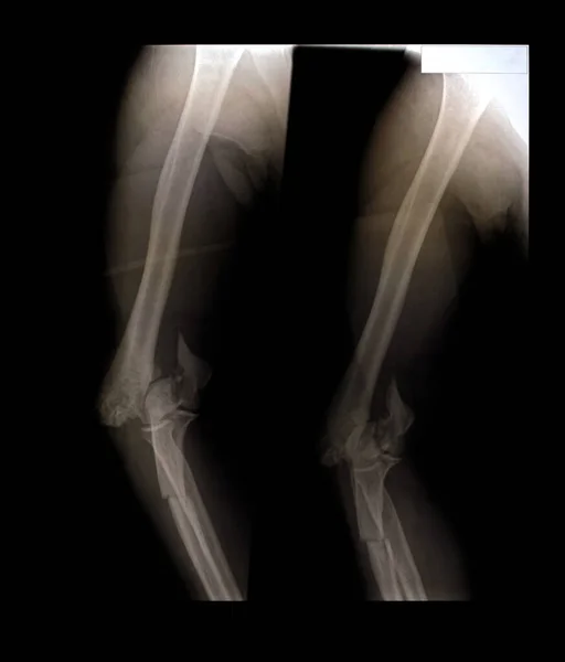 An X-ray film of the arm fracture in an accident for diagnosis in the treatment of diseases X-ray film images taken from the x-ray room for diagnosis of faults that require surgery for medical