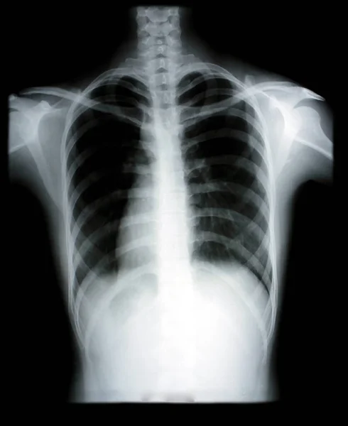 胸部X線フィルムの写真と病気の治療における診断のための呼吸器系X線フィルム画像は 医療のための手術を必要とする障害の診断のためのX線室から撮影されました — ストック写真