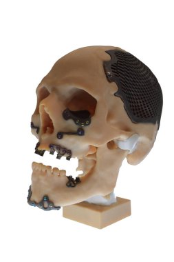 Kurulmuş protezleri olan insan kafatası modeli.. 