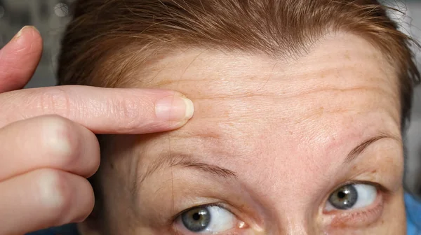 Female Forehead Wrinkles Enlarged Pores Close Skin Care Years Horizontal — Stock Photo, Image