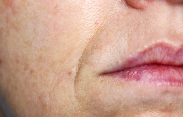 Pliegues Nasolabiales Poros Agrandados Cara Femenina Cuidado Piel Años Primer Fotos De Stock