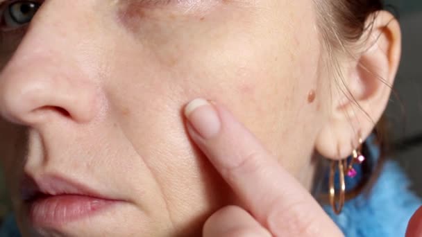Die Haut Einer Älteren Frau Mit Pickeln Und Vergrößerten Poren — Stockvideo