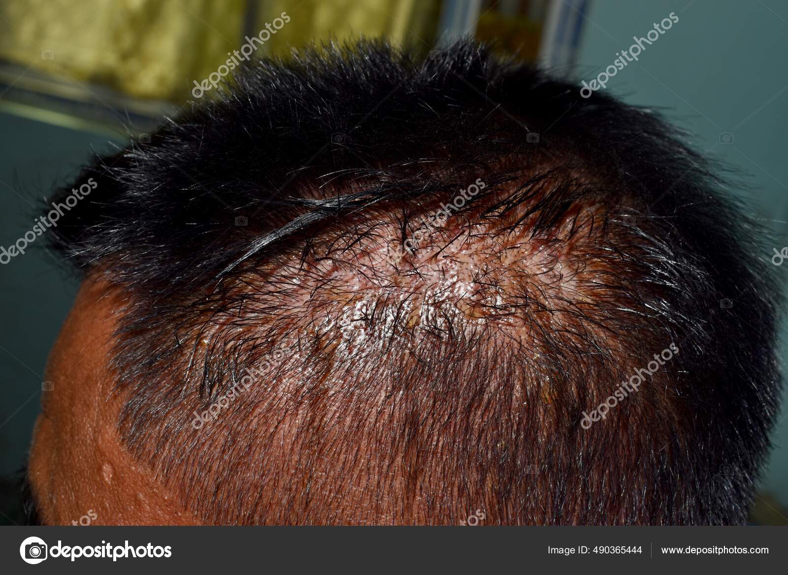 Seborrheic Dermatitis Scalp Southeast Asian Myanmar Adult Male Patient Lateral Stock Photo by ©zaynyinyi 490365444 Seborrheic Dermatitis Scalp Southeast Asian Myanmar Adult Male Patient Lateral Stock Photo by ©zaynyinyi 490365444
