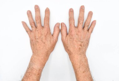 Age spots on hands of Asian elder man. They are brown, gray, or black spots and also called liver spots, senile lentigo, solar lentigines, or sun spots. Isolated on white background. clipart