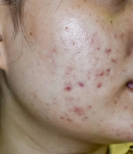 acne vulgaris and scars over whole face of Southeast Asian woman. Acne occurs when hair follicles become plugged with oil and dead cells. It causes whiteheads, blackheads or pimples.