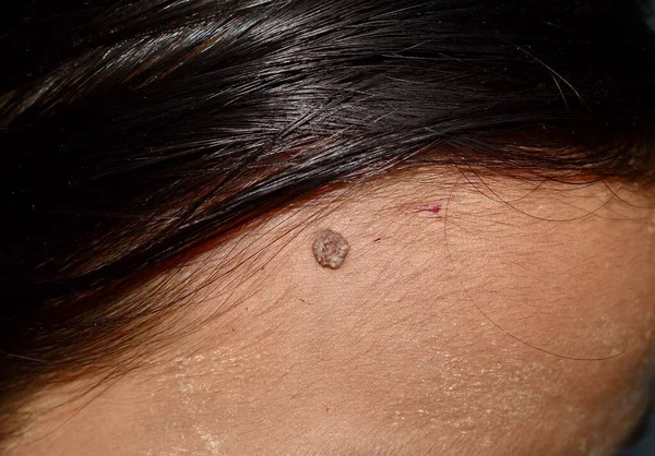 Intradermal Nevus Single Mole Forehead Southeast Asian Myanmar Young Woman — 图库照片