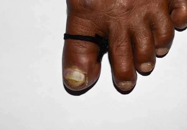 Острая Паронихия Жгут Большом Пальце Ноги Человека Юго Восточной Азии — стоковое фото