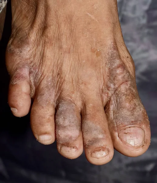 Eczema or fungal infection in foot of Asian man. Closeup view.