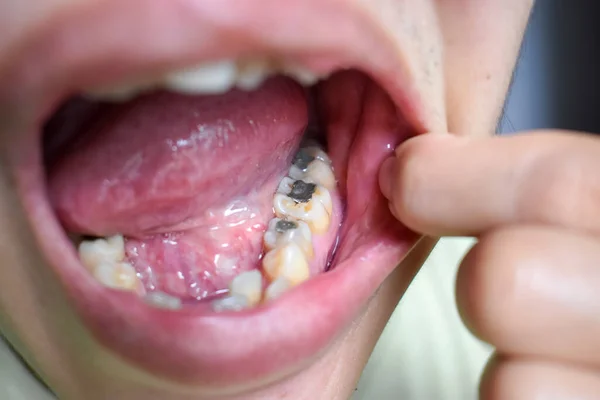 Silver amalgam fillings at right lower first molar and left lower second premolar teeth in Asian, young man. Dental caries are also present showing poor oral hygiene.