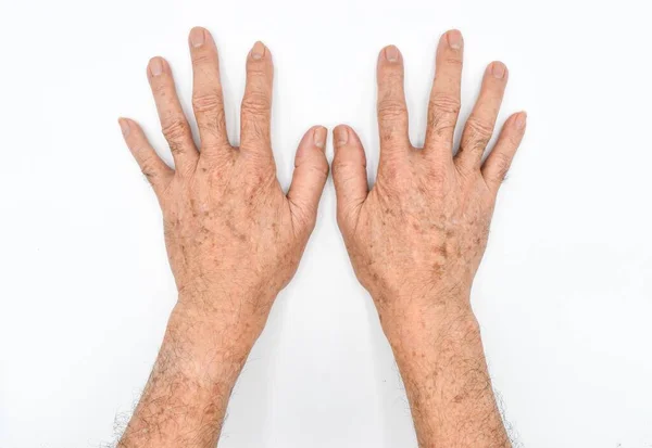 Возрастные Пятна Руках Азиатского Пожилого Человека Коричневые Серые Чёрные Пятна — стоковое фото