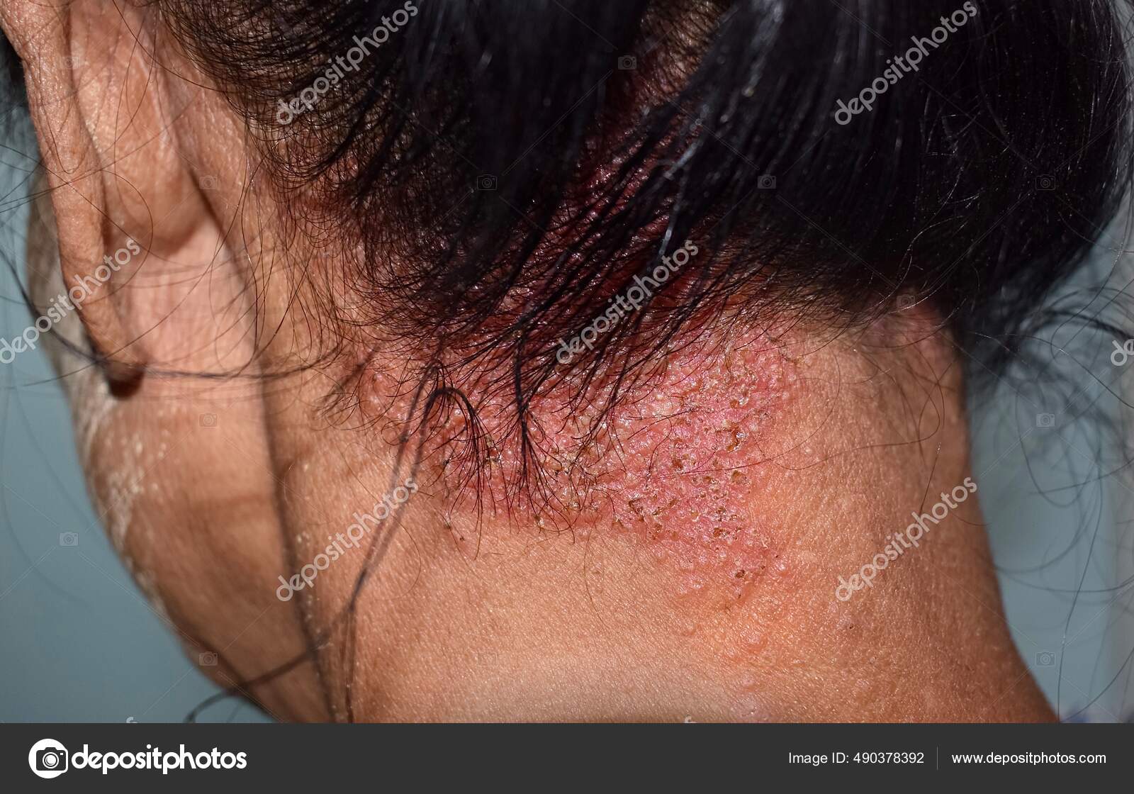 Fungal Rash On Neck Deals Shop Clc cet edu