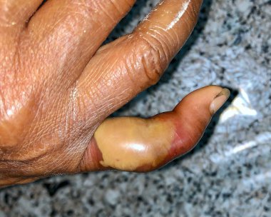 Asyalı Birmanyalı erkek hastanın orta parmağında iltihaplı apse ya da Staphylococcal / Streptococcal deri enfeksiyonu.