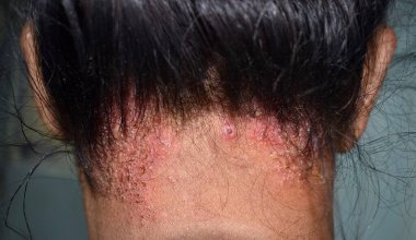 Seborrheic dermatitis or fungal skin infection at the scalp of Southeast Asian, Myanmar adult female patient. Back view. clipart