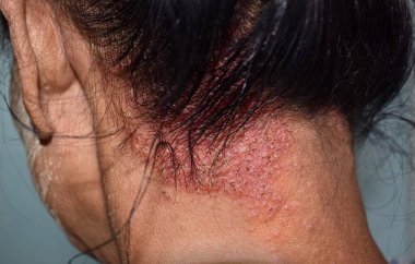 Güneydoğu Asyalı yetişkin Myanmar kadın hastasının kafa derisinde seborrheic dermatit veya mantar derisi enfeksiyonu. Sol yanal görünüm.