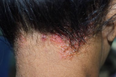Güneydoğu Asyalı yetişkin Myanmar kadın hastasının kafa derisinde seborrheic dermatit veya mantar derisi enfeksiyonu. Sağ yan görünüm.