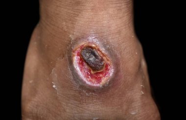 Güneydoğu Asya 'da, Burmalı, yetişkin erkek hastalarda kronik ülser ya da ayak sırtı yarası. Siyah arkaplanda izole.