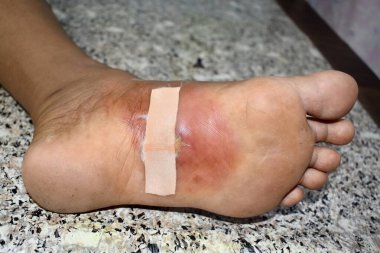Steril, tek kullanımlık, diyabetik ayak ülserine uygulanan elastik plastik. Yara bakımı. Selülit mevcut.