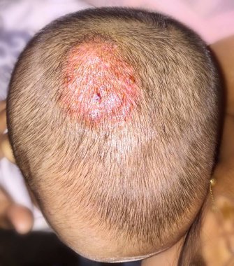 Treated Tinea Capitis or Fungal Infection on Scalp of Southeast Asian, Burmese two years old  Child in Clinic clipart