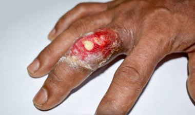 Asyalı Birmanyalı bir hastanın orta parmağında acı verici çıban ya da iltihaplı apse ya da Staphylococcal / Streptococcal deri enfeksiyonu. Beyazda izole edilmiş.