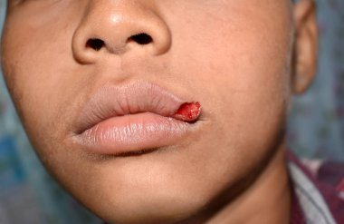 Small lacerated wound in lip of Asian, child. Closeup view. clipart