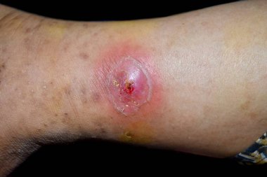 Asyalı Burmalı bir hastanın sağ bacağında iltihaplı apse ya da Staphylococcal / Streptococcal deri enfeksiyonu var. Yakından bak. Siyah üzerine izole edilmiş..