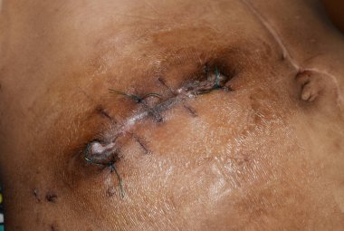 Düzensiz Kocher 'ın ensizyonu ya da kolesistektomi için subkostal ya da obsesif ensizyon. İltihaplı dikişler ya da yara. Aynı zamanda karaciğer ve safra yolu ameliyatı için de yapılır..