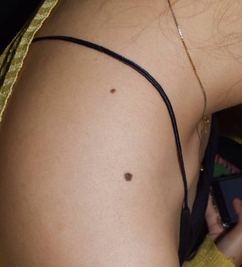 Junctional nevus ya da Güneydoğu Asyalı genç Myanmar 'ın omzunda çift köstebek. Üst deriyle deri tabakaları arasındaki sınırda bulunurlar. Bu benler renkli ve hafifçe yükseltilmiş olabilir..
