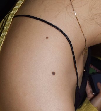 Junctional nevus or double moles at shoulder of Southeast Asian, Myanmar young woman. It is found at border between epidermis and dermis layers of skin. These moles may be colored and slightly raised. clipart