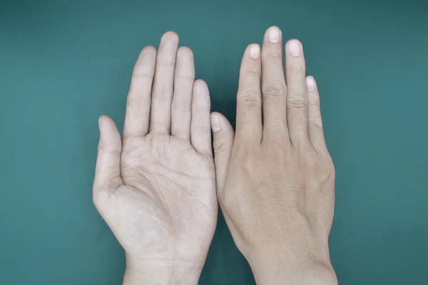 Pale palmar surface of both hands. Anaemic hands of Asian, Chinese man. Isolated on green background.