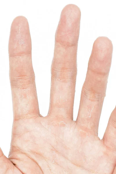 Sweaty Hand Asian Young Man Closeup View Isolated White Background — Stock Photo, Image