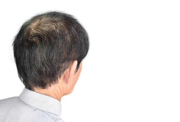 Thinning or sparse hair, male pattern hair loss in Southeast Asian, Chinese elder man. With text space. Isolated on white.