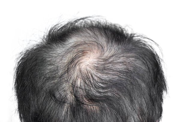 Thinning or sparse hair, male pattern hair loss in Southeast Asian, Chinese elder man. Isolated on white.
