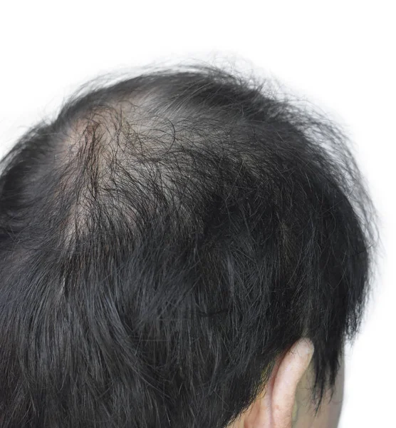 Thinning Sparse Hair Male Pattern Hair Loss Southeast Asian Chinese — Stock Photo, Image