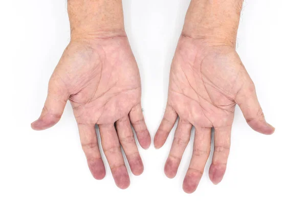 동남아시아의 청록색 선천성 질환을 중국의 Cyanotic Hands Cyanosis 파란색 — 스톡 사진