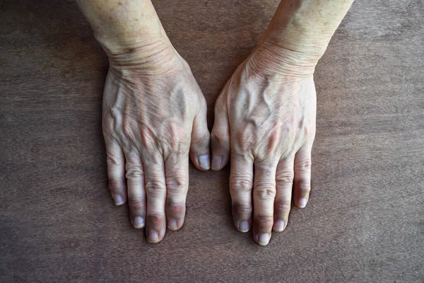 Cyanotic Hands Peripheral Cyanosis Blue Hands Southeast Asian Chinese Woman — 图库照片