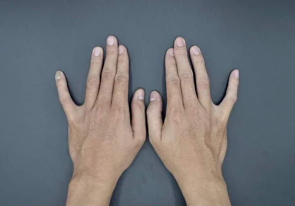 Bilateral Little Finger Deviation Asian Young Man Bilateral Hand Deformities — 图库照片