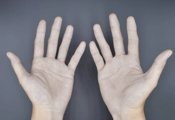 Бледная Ладонь Обеих Рук Анемичные Руки Азиата Китайца Изолированный Сером — стоковое фото