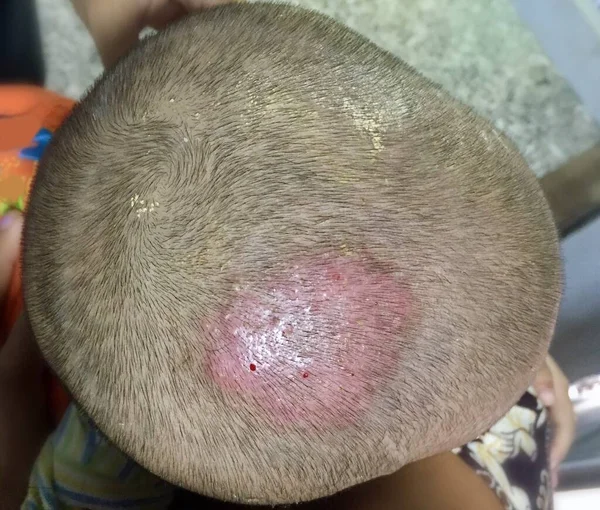 Tedavi Edilen Tinea Capitis veya Güneydoğu Asya Kafa Derisinde Mantar Enfeksiyonu, Birmanya Kliniğinde İki Yaşındaki Çocuk