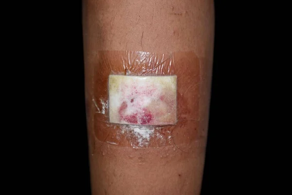 Non Absorbent Island Wound Dressing Bandage Wound Due Accidental Injury — 图库照片