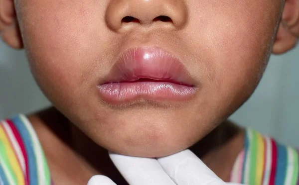 Angioedema Los Labios Del Niño Del Sudeste Asiático Niño Edematoso —  Fotos de Stock