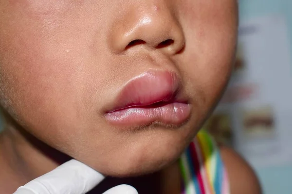 Angioedema Los Labios Niña Del Sudeste Asiático Niño Edematoso Causada —  Fotos de Stock