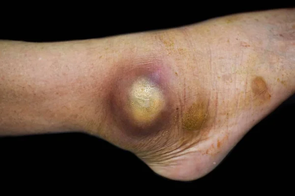 Large Abscess Cellulitis Foot Asian Burmese Elderly Male Patient Clinic — 图库照片