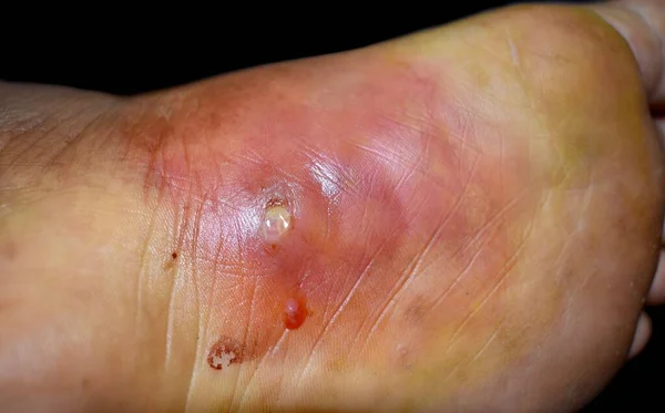 东南亚男性患者脚部意外钉刺伤 结肠炎和即将发生的脓肿 糖尿病溃疡 应使用抗破伤风疫苗 — 图库照片