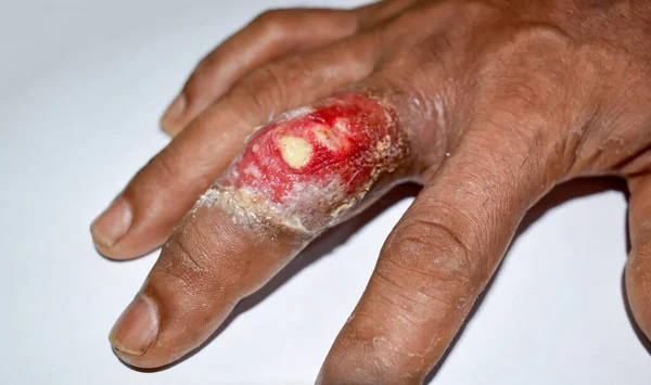 Painful Carbuncle Abscess Surrounding Cellulitis Staphylococcal Streptococcal Skin Infection Middle — 图库照片
