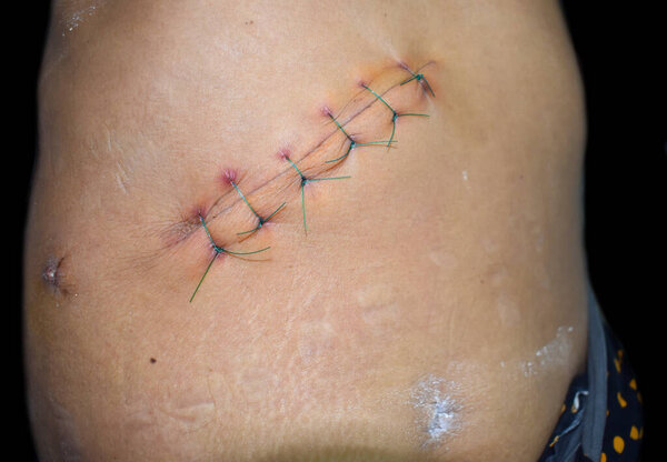 Kocher's incision or subcostal or oblique incision for open cholecystectomy. Infected stitches or wound. It is also done for surgery of liver and biliary tract.